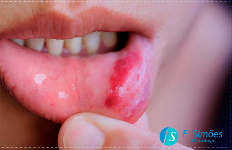Sintomas do câncer de boca que não podem ser ignorados